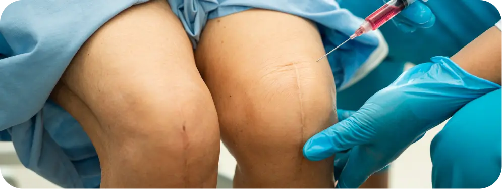 Doctor performing knee injection during evaluation of meniscus tear and circumferential compression stitch treatment